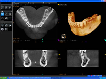 歯科用CT