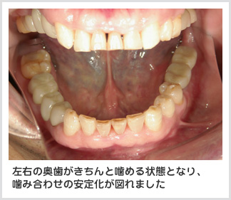 インプラント