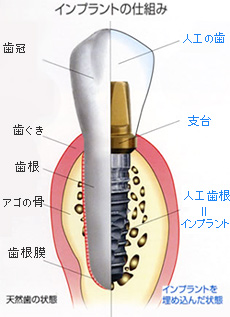 インプラント