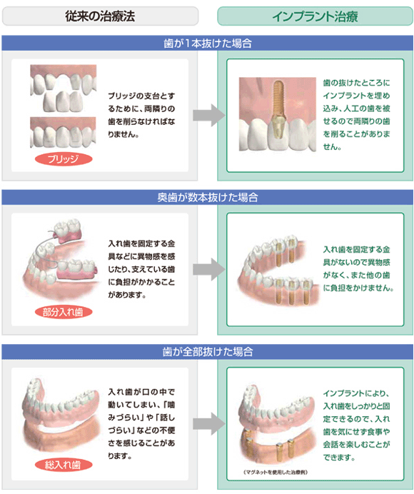 従来の治療法とインプラント治療法との比較