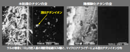 インプラント