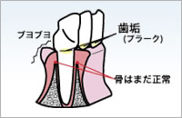 歯周病治療