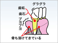 歯周病治療