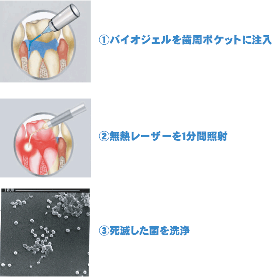 ペリオウェーブ